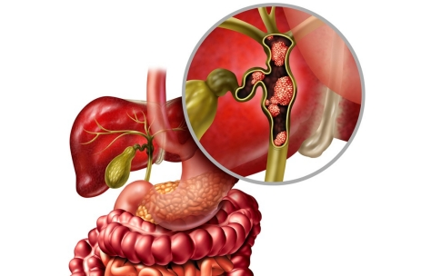 重磅突破!Zanidatamab显著延长胆道癌患者生存期,开启靶向治疗新时代!