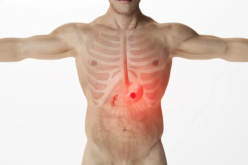 胃癌患者是否应该去日本治疗?日本看病的优势及胃癌医院推荐 胃癌患者是否应该去日本治疗?日本看病的优势及胃癌医院推荐