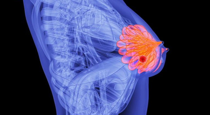 刚刚,晚期乳腺癌新药获批上市,肿瘤缩小率翻倍!耐药难题被破解?